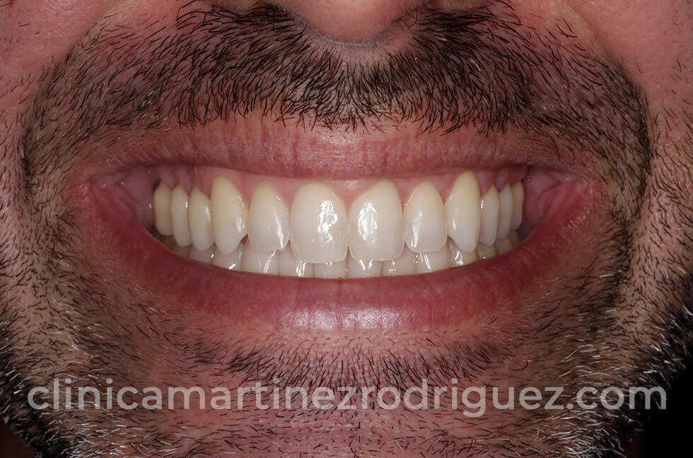After image