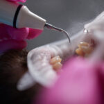 Sarro dental como quitar